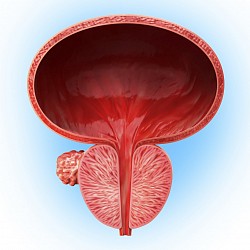 hiperplasia prostatica benigna : El agrandamiento de la próstata puede causar síntomas molestos, como bloquear el flujo de orina desde la vejiga. También puede causar problemas en la vejiga, las vías urinarias o los riñones.