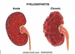 Pielonefritis.: Es una causa frecuente de formación de cicatrices en los riñones y puede llevar a la pérdida parcial de la función renal, especialmente en pacientes que tienen infecciones recurrentes.