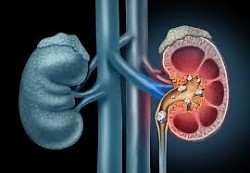 litiasis renal.: Enfermedad causada por la presencia de cálculos o piedras en el interior de los riñones o de las vías urinarias (uréteres o vejiga). También se la denomina urolitiasis o nefrolitiasis.
