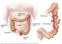DIVERTÍCULOS EN EL COLON
