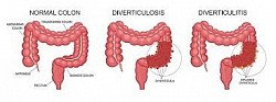 COLON NORMAL, COLON CON DIVERTICULOSIS Y COLON CON DIVERTICULITIS