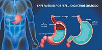 REFLUJO GASTROESOFÁGICO