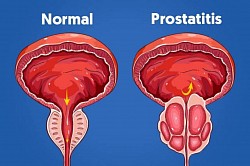 Prostatitis: Inflamación de la prostata