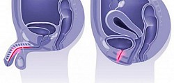 Uretritis: Inflamación de la uretra