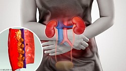 Nefritis: Inflamación de riñón