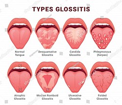 Glositis: Inflamación de la lengua
