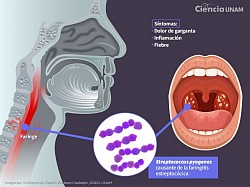 Faringitis: Inflamación de la faringe