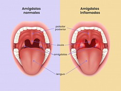 Amigdalitis: Inflamación de las amigdalas