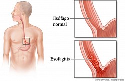 Esofagitis: Inflamación del esófago