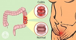 Colitis: Inflamación del colon
