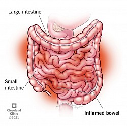 Enteritis: Inflamación del intestino delgado